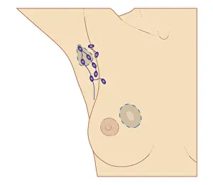 Breast Prints: Cross section biomedical illustration of breast cancer tumour and lymph nodes requiring lumpectomy procedure