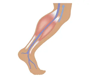 Human Limb Prints: Cross section biomedical illustration of calf muscle contraction constricting femoral artery in human leg
