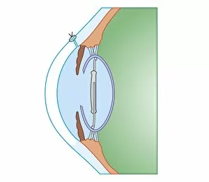 Cross section biomedical illustration of cataract surgery