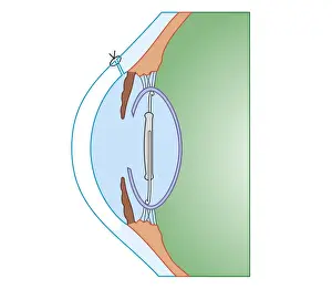 Cataract Prints: Cross section biomedical illustration of cataract surgery