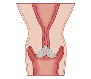 Cervix Prints: Cross section biomedical illustration of Cervical conization biopsy of cervical intraepithelial neoplasia