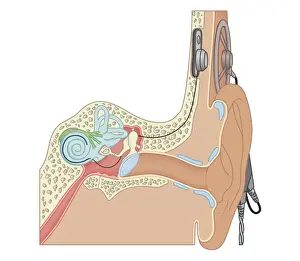 Deafness Prints: Cross section biomedical illustration of cochlear implants