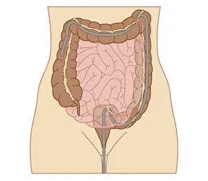 Colon Prints: Cross section biomedical illustration of colonoscopy procedure in adult female