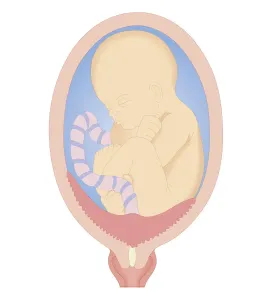 Uterus Prints: Cross section biomedical illustration of complete placenta praevia