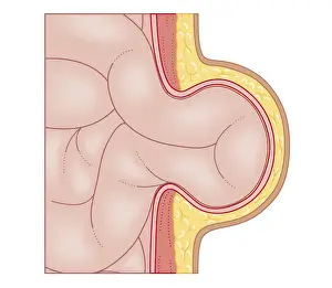 Human Intestine Prints: Cross section biomedical illustration of development of hernia