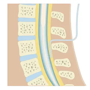 Human Spine Prints: Cross section biomedical illustration of epidural anaesthesia during labour