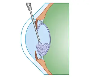 Softness Prints: Cross section biomedical illustration of eye cataract surgery sucking softened tissue out using ultrasound probe