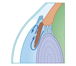 Eyesight Prints: Cross section biomedical illustration of fluid flow in chronic glaucoma