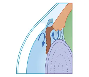 Series Prints: Cross section biomedical illustration of fluid flow in chronic glaucoma with blocked trabecular meshwork