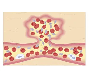 Problem Prints: Cross section biomedical illustration of formation of blood clot with damaged blood vessel constricting