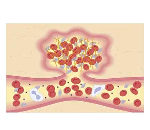 Problem Prints: Cross section biomedical illustration of formation of blood clot by protein fibrogen converting into insoluble fibrin