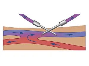 Removing Prints: Cross section biomedical illustration of Haemodialysis showing needle inserted into vein