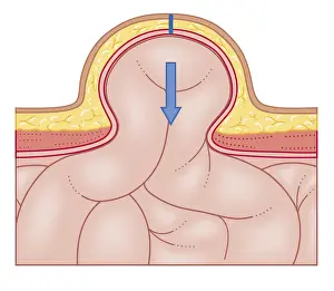 Operating Prints: Cross section biomedical illustration of hernia repair and site of incision to uncover the hernia