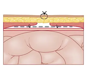 Tied Up Prints: Cross section biomedical illustration of hernia repair using synthetic mesh
