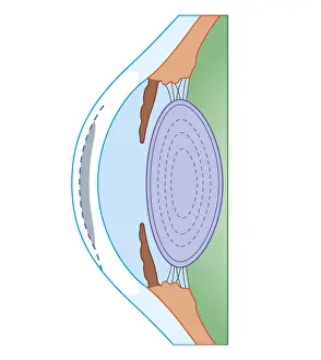 Eyesight Prints: Cross section biomedical illustration of human eye before corrective surgery for myopia