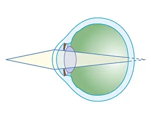 Eyesight Prints: Cross section biomedical illustration of hypermetropia
