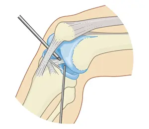 Human Leg Prints: Cross section biomedical illustration of inside the knee joint during rigid endoscopy procedure