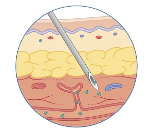 Skin Prints: Cross section biomedical illustration of intramuscular drug injected into muscle dispersing into bloodstream