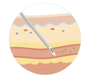 Syringe Prints: Cross section biomedical illustration of intravenous route of drugs injected into blood vessel for rapidly circulation