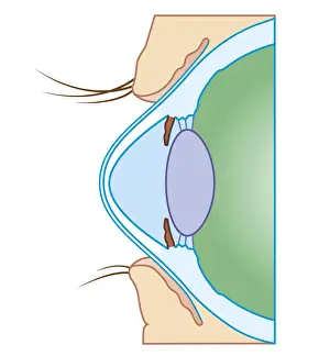 Cone Prints: Cross section biomedical illustration of keratoconus or conical cornea