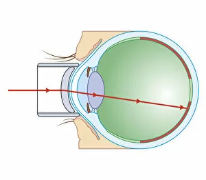 Images Dated 21st October 2011: Cross section biomedical illustration of laser surgery for retinopathy