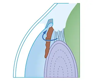 Eyesight Prints: Cross section biomedical illustration of laser iridectomy treatment technique for acute glaucoma