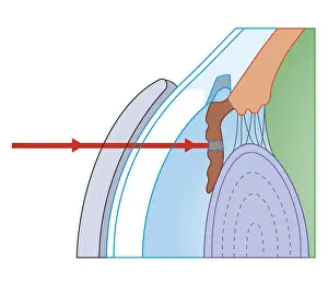 Eyesight Prints: Cross section biomedical illustration of laser iridotomy where laser beam is focused on iris through thick contact lens