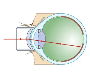 Eyesight Prints: Cross section biomedical illustration of laser surgery for retinopathy