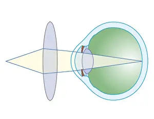 Eyesight Prints: Cross section biomedical illustration of lens to correct hypermetropia