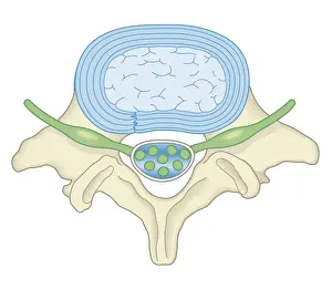 Cross section biomedical illustration of lumber microdisectomy after surgery