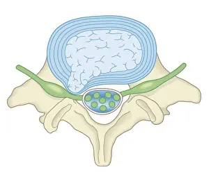 Vertebra Prints: Cross section biomedical illustration of lumber microdisectomy before surgery