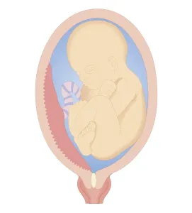 Uterus Prints: Cross section biomedical illustration of marginal placenta praevia