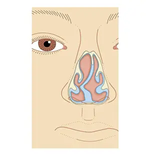Nasal Cavity Prints: Cross section biomedical illustration of nasal septum deviation, close-up
