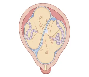 Uterus Prints: Cross section biomedical illustration of non identical twins in uterus with separate placentas
