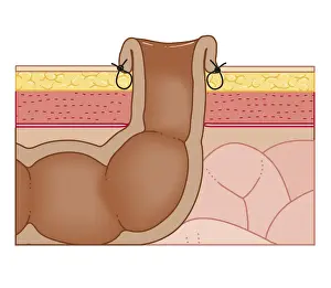 Colon Prints: Cross section biomedical illustration of permanent colostomy with colon sutured to abdominal wall