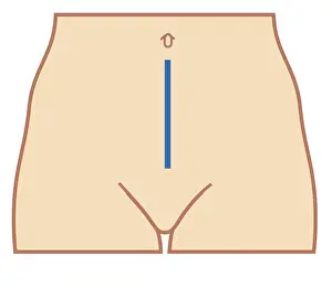 Mid Section Prints: Cross section biomedical illustration of position of colectomy incision