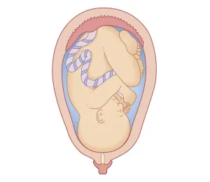 Uterus Prints: Cross section biomedical illustration of position foetus at first stage of labour