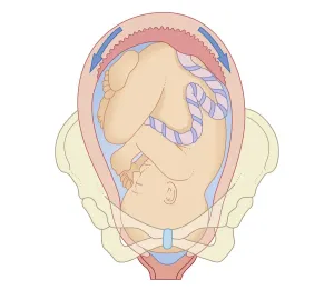 Uterus Prints: Cross section biomedical illustration of position foetus in pelvis at first stage of labour