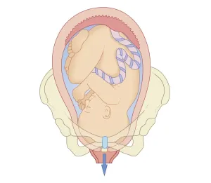 Uterus Prints: Cross section biomedical illustration of position foetus in pelvis at first stage of labour