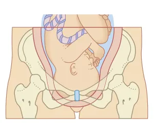 Uterus Prints: Cross section biomedical illustration of position of foetus in uterus after engagement process