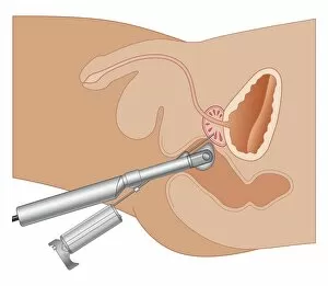 Images Dated 21st October 2011: Cross section biomedical illustration of prostate gland needle biopsy procedure