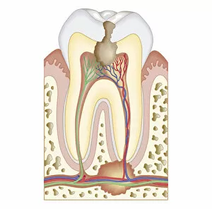 Images Dated 24th October 2011: Cross section biomedical illustration of pulp and root abscess in molar