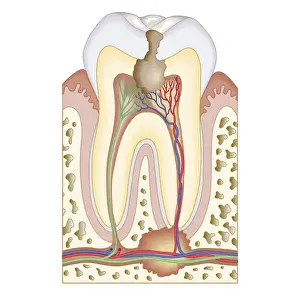 Roots Prints: Cross section biomedical illustration of pulp and root abscess in molar