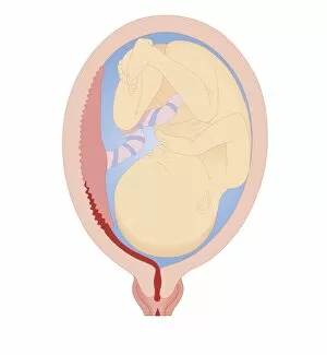Images Dated 24th October 2011: Cross section biomedical illustration of revealed placental abruption