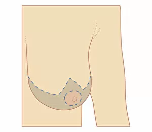 Images Dated 21st October 2011: Cross section biomedical illustration of site of breast reduction