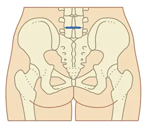 Pelvis Prints: Cross section biomedical illustration of site of incision for microdiscectomy surgical procedure