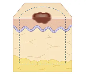 Scrutiny Prints: Cross section biomedical illustration of site of skin biopsy