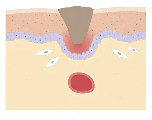Wounded Prints: Cross section biomedical illustration of skin repair with fibroblast forming plug within Thrombus (blood clot)