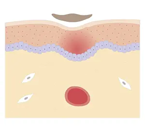 Skin Prints: Cross section biomedical illustration of skin repair with fibrous plug hardening to become scab which falls off when
