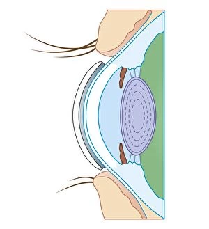 Soft Gallery: Cross section biomedical illustration of soft contact lens on eye